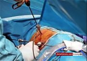 پزشک ایرانی با 7075 عمل جراحی پیوند کلیه چهره جهان شد