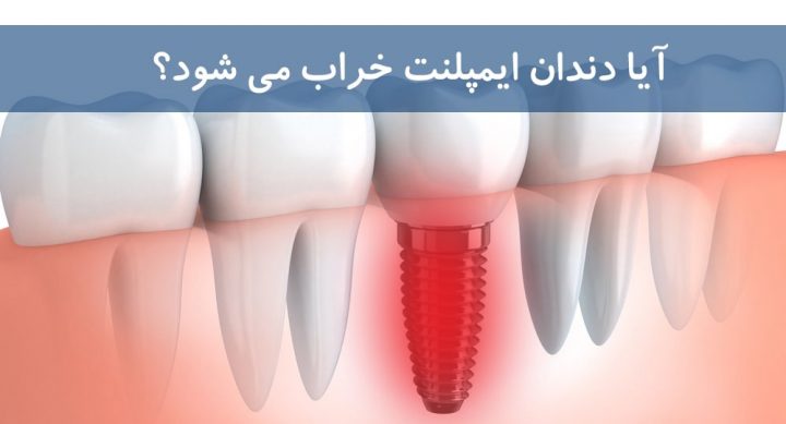 آیا ایمپلنت دندان خراب می شود؟